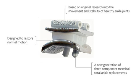 BOX® Total Ankle Replacement